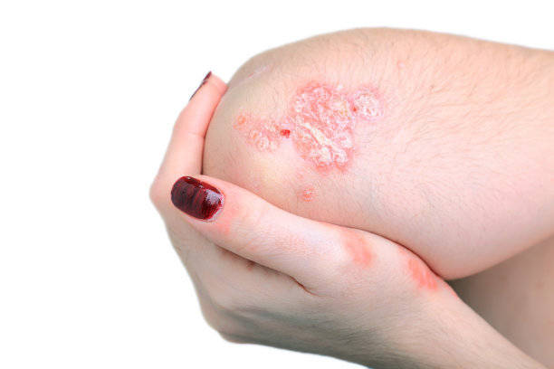 有效治疗湿疹的最好方法是什么？【三亿体育官网】(图2)